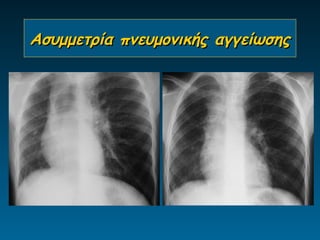 Ασυμμετρία πνευμονικής αγγείωσης
 
