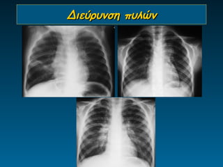 Διεύρυνση πυλών
 