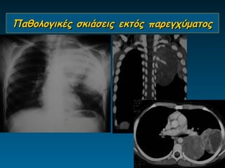 Παθολογικές σκιάσεις εκτός παρεγχύματος
 