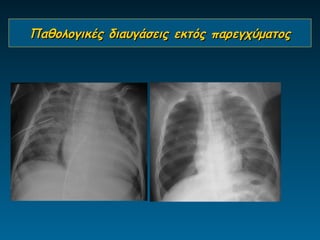 Παθολογικές διαυγάσεις εκτός παρεγχύματος
 