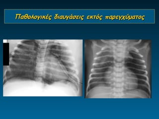 Παθολογικές διαυγάσεις εκτός παρεγχύματος
 