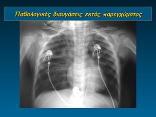 Παθολογικές διαυγάσεις εκτός παρεγχύματος
 
