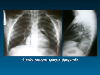 4 ετών λαρυγγο-τραχειο-βρογχίτιδα
 