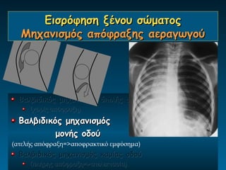 Εισρόφηση ξένου σώματος
  Μηχανισμός απόφραξης αεραγωγού




  Βαλβιδικός μηχανισμός διπλής οδού
     (χωρίς απόφραξη)
  Βαλβιδικός μηχανισμός
           μονής οδού
(ατελής απόφραξη=>αποφρακτικό εμφύσημα)
  Βαλβιδικός μηχανισμός καμίας οδού
     (πλήρης απόφραξη=>ατελεκτασία)
 