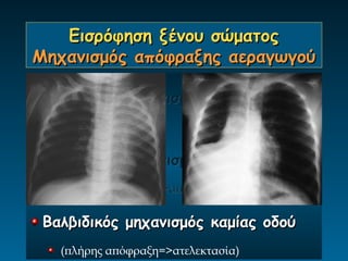 Εισρόφηση ξένου σώματος
Μηχανισμός απόφραξης αεραγωγού

 Βαλβιδικός μηχανισμός διπλής οδού
   (χωρίς απόφραξη)

 Βαλβιδικός μηχανισμός μονής οδού
   (ατελής απόφραξη=>αποφρακτικό εμφύσημα)

 Βαλβιδικός μηχανισμός καμίας οδού
   (πλήρης απόφραξη=>ατελεκτασία)
 