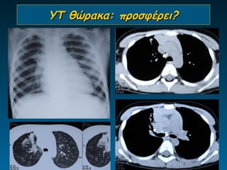 ΥΤ θώρακα: προσφέρει?
 