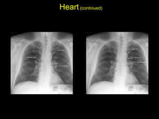 Heart(continued)