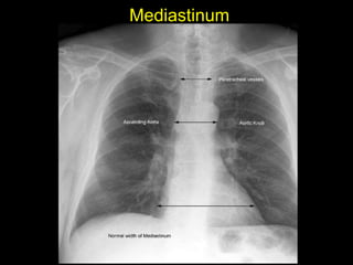 Mediastinum