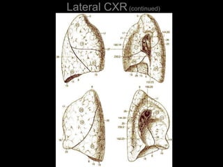 Lateral CXR(continued)