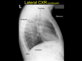 Lateral CXR(continued)