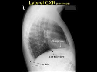 Lateral CXR(continued)