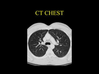 CT CHEST