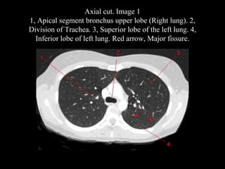 Axial cut. Image 1
1, Apical segment bronchus upper lobe (Right lung). 2,
Division of Trachea. 3, Superior lobe of the left lung. 4,
Inferior lobe of left lung. Red arrow, Major fissure.