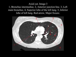 Axial cut. Image 3
1, Bronchus intermedius. 2, Anterior junction line. 3, Left
main bronchus. 4, Superior lobe of the left lung. 5, Inferior
lobe of left lung. Red arrow, Major fissure.