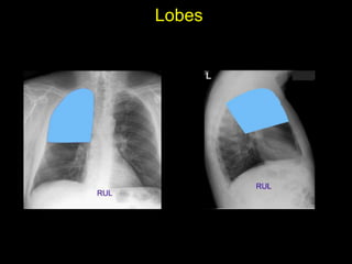 Lobes
• Right upper lobe: