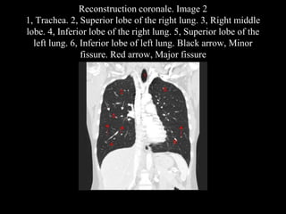 Reconstruction coronale. Image 2
1, Trachea. 2, Superior lobe of the right lung. 3, Right middle
lobe. 4, Inferior lobe of the right lung. 5, Superior lobe of the
left lung. 6, Inferior lobe of left lung. Black arrow, Minor
fissure. Red arrow, Major fissure