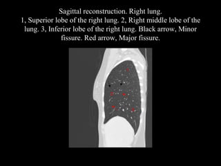 Sagittal reconstruction. Right lung.
1, Superior lobe of the right lung. 2, Right middle lobe of the
lung. 3, Inferior lobe of the right lung. Black arrow, Minor
fissure. Red arrow, Major fissure.