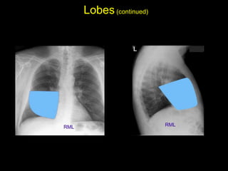 Lobes(continued)
• Right middle lobe: