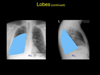 Lobes(continued)
• Right lower lobe: