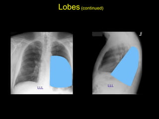 Lobes(continued)
• Left lower lobe: