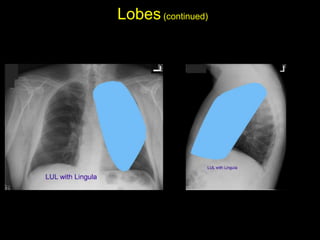 Lobes(continued)
• Left upper lobe with Lingula: