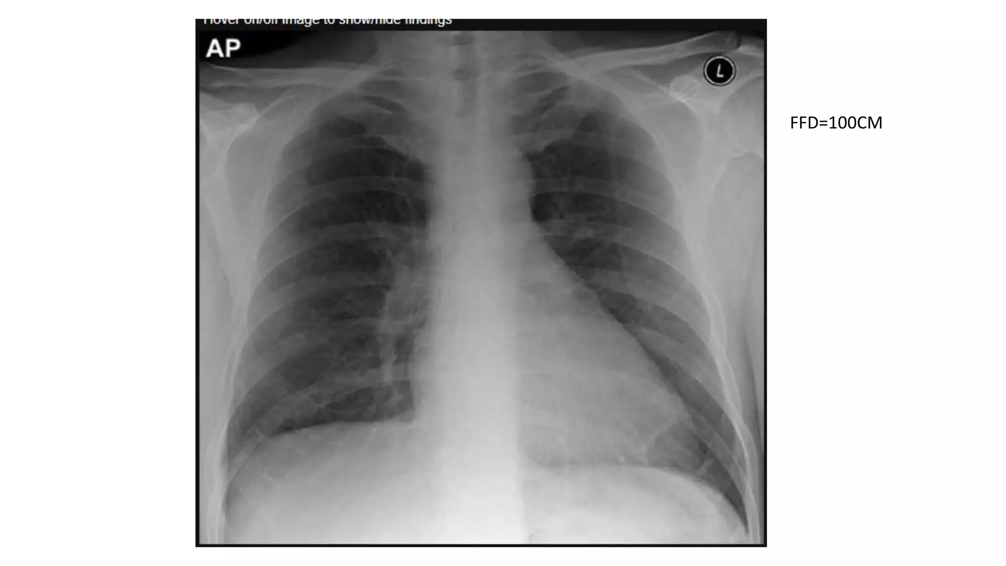 Sternum Radiography Positioning Chest radiography positioning and Technique.pptx