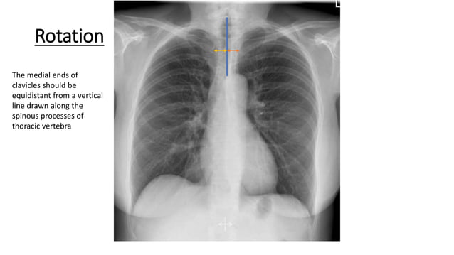 Sternum Radiography Positioning Chest radiography positioning and Technique.pptx | Death, Injury, or ...