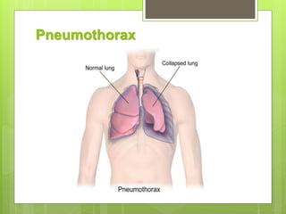 Pneumothorax
 