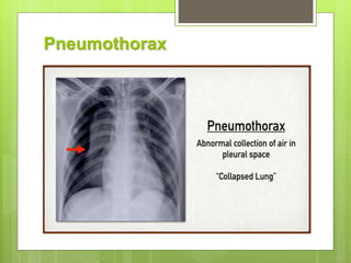 Pneumothorax
 