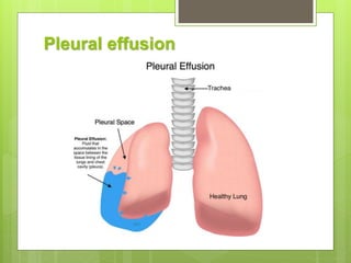 Pleural effusion
 