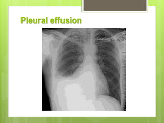 Pleural effusion
 