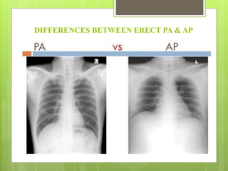 DIFFERENCES BETWEEN ERECT PA & AP
 