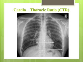 Cardio – Thoracic Ratio (CTR)
 