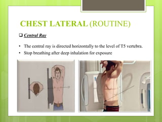 CHEST LATERAL (ROUTINE)
 Central Ray
• The central ray is directed horizontally to the level of T5 vertebra.
• Stop breathing after deep inhalation for exposure
 