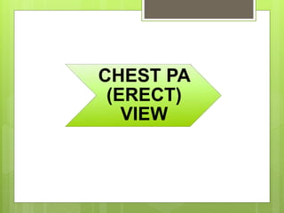 CHEST PA
(ERECT)
VIEW
 
