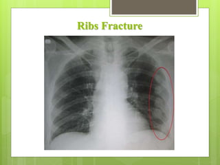 Ribs Fracture
 