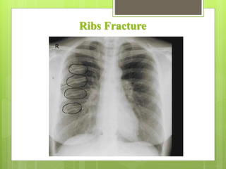 Ribs Fracture
 
