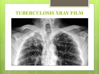 TUBERCULOSIS XRAY FILM
 