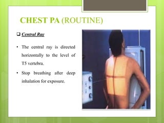 CHEST PA (ROUTINE)
 Central Ray
• The central ray is directed
horizontally to the level of
T5 vertebra.
• Stop breathing after deep
inhalation for exposure.
 