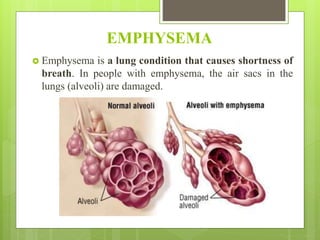 EMPHYSEMA
 Emphysema is a lung condition that causes shortness of
breath. In people with emphysema, the air sacs in the
lungs (alveoli) are damaged.
 