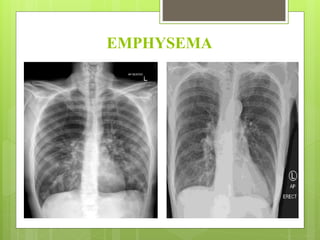 EMPHYSEMA
 