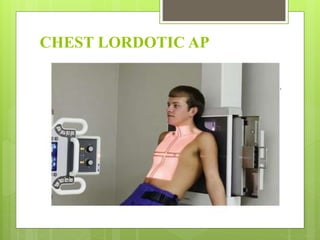 CHEST LORDOTIC AP
 