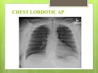 CHEST LORDOTIC AP
 