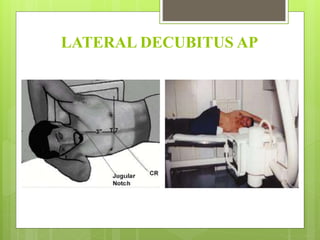 LATERAL DECUBITUS AP
 