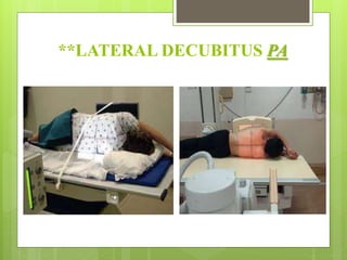 **LATERAL DECUBITUS PA
 