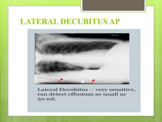 LATERAL DECUBITUS AP
 