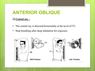 ANTERIOR OBLIQUE
 Central ray –
• The central ray is directed horizontally at the level of T5.
• Stop breathing after deep inhalation for exposure.
 