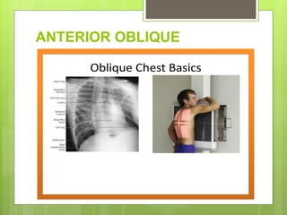 ANTERIOR OBLIQUE
 