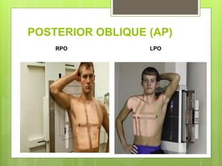 POSTERIOR OBLIQUE (AP)
RPO LPO
 