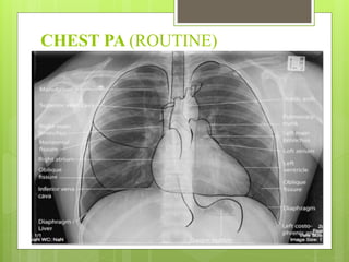 CHEST PA (ROUTINE)
 